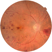 Sağlıklı fundus