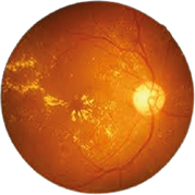 Sağlıklı fundus